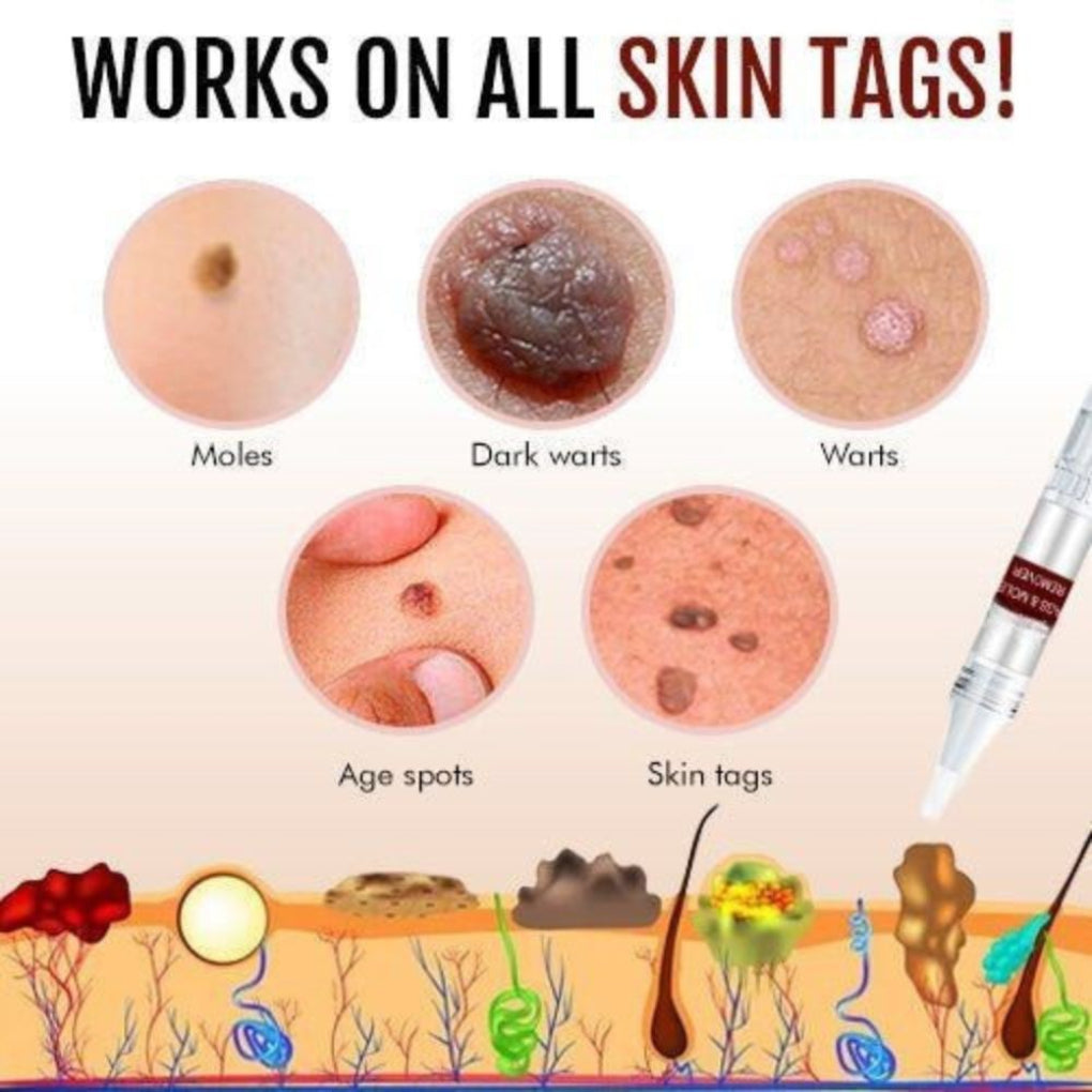 Tags And  Moles Remover